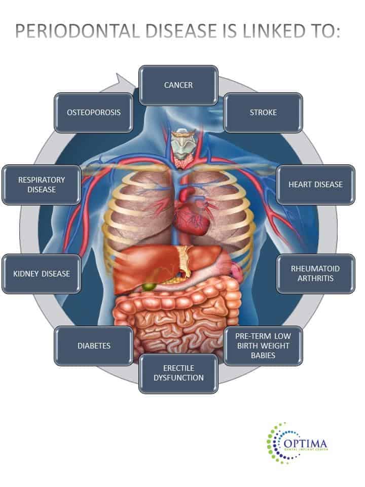 perio disease linked to