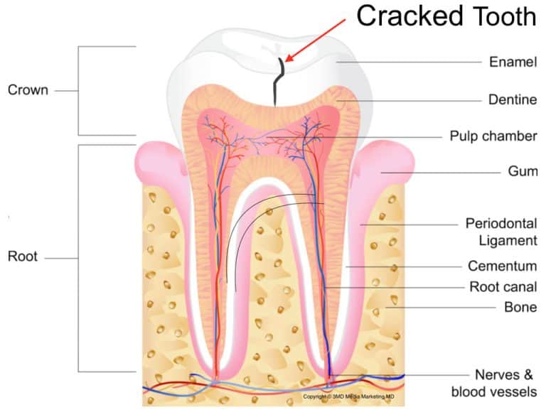 cracked tooth 1