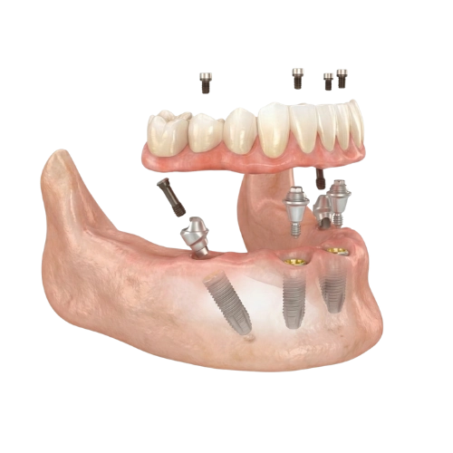 Dental Implant Placement for Restorative Dentistry Dental model showing implants supporting an upper denture above a jawbone.