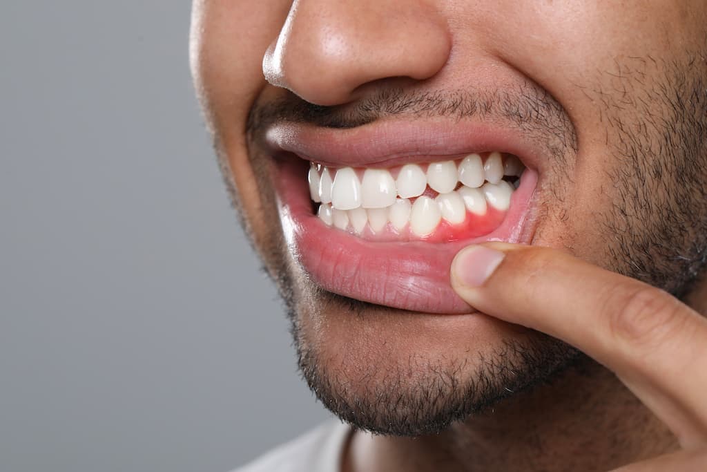Man pulling down lower lip to reveal inflamed gums.