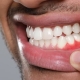 Gum disease treatment options