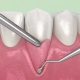 Gum Graft Recovery