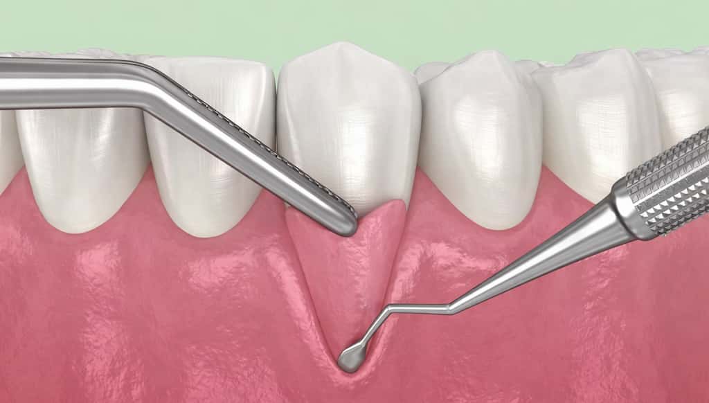Gum Graft Recovery