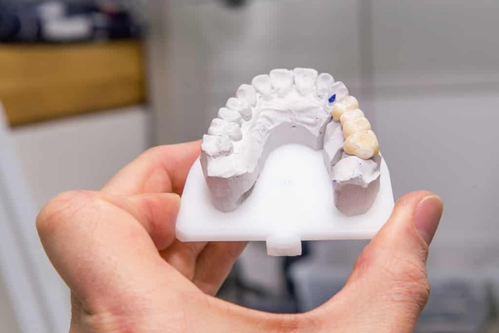 Dental Implant vs Bridge: Which One Should You Choose?
