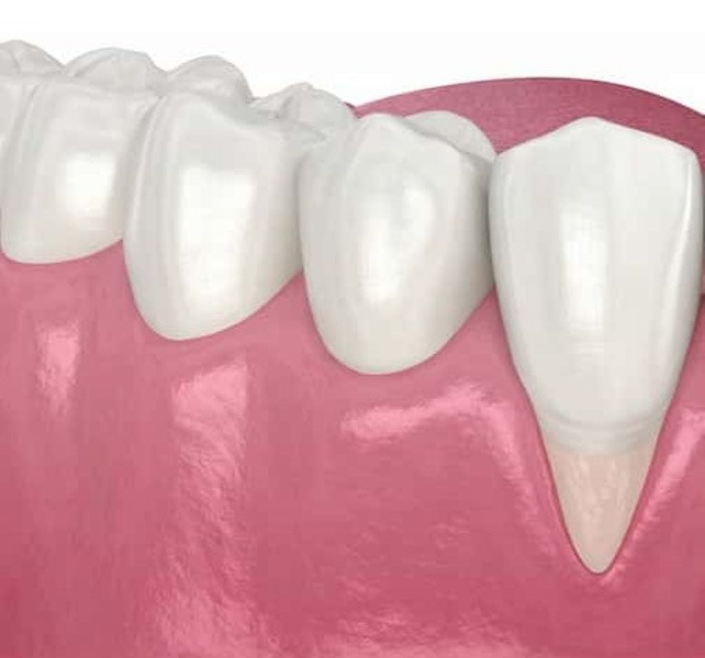 Gum Recession Signs: Recognizing the Early Warnings Your Mouth Is Sending