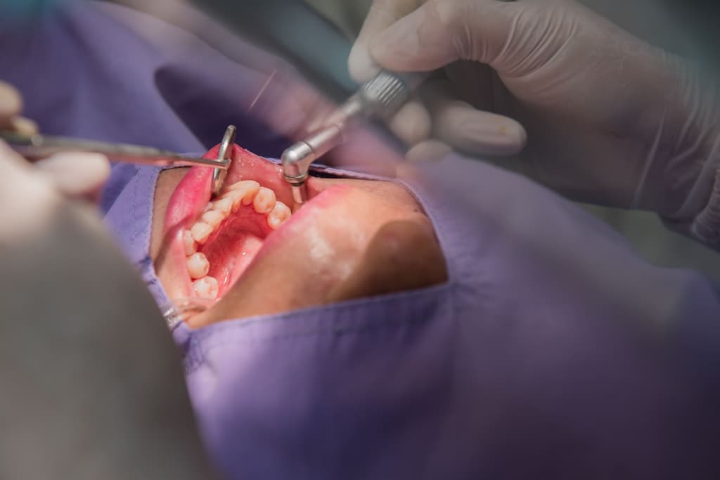 A dentist performs a procedure on a patient's open mouth.