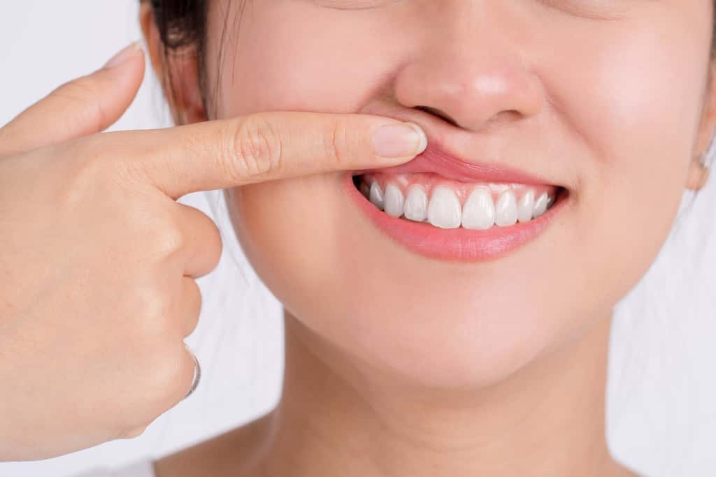 Person smiling, lifting their upper lip to show their teeth and gums.