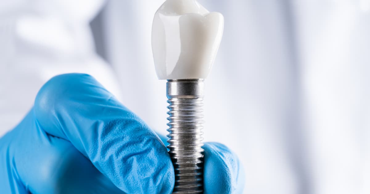 Single-Tooth Denture vs Implant - Patient Guide