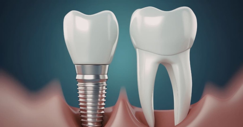 Single-tooth denture vs implant