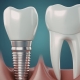 Single-tooth denture vs implant